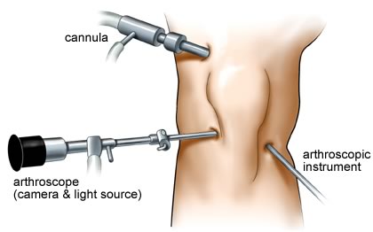 Arthroscopic Surgery in Delhi
