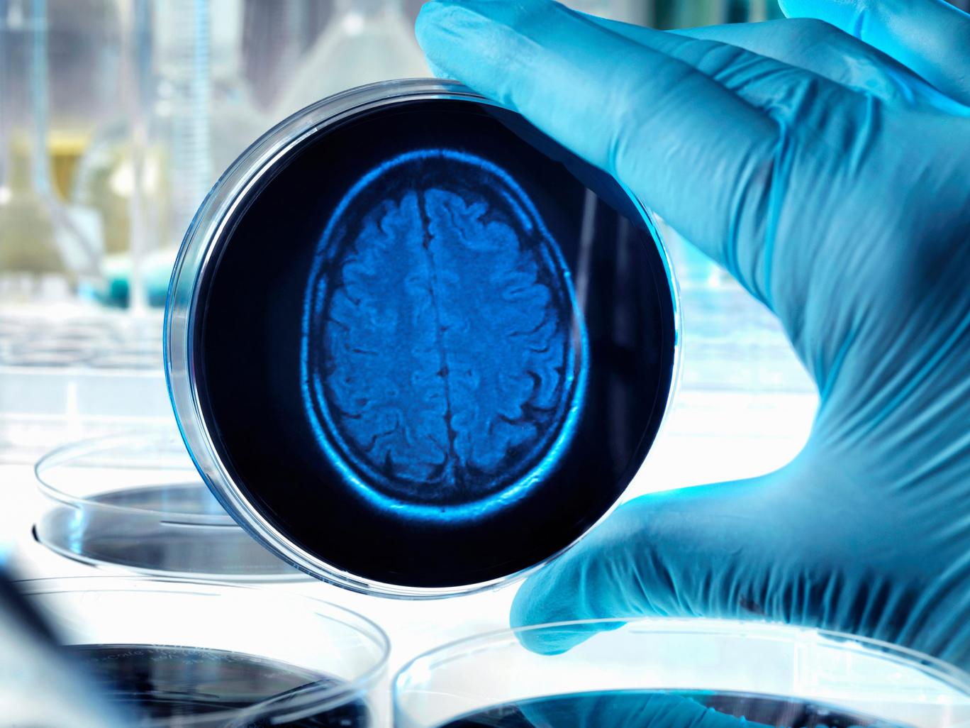 Blocking inflammation in the brain 'stops Alzheimer's disease progressing